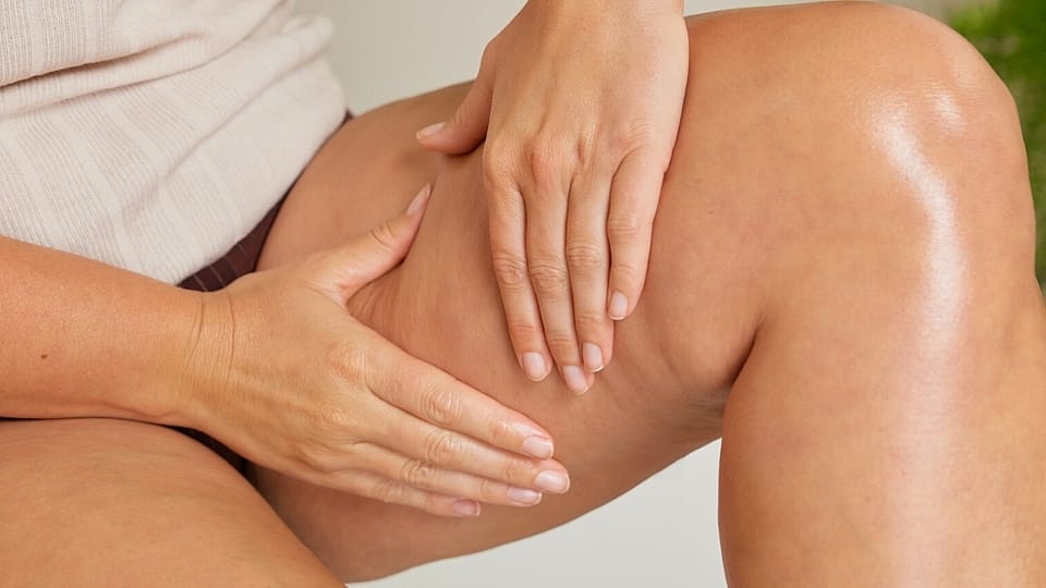Cellulite